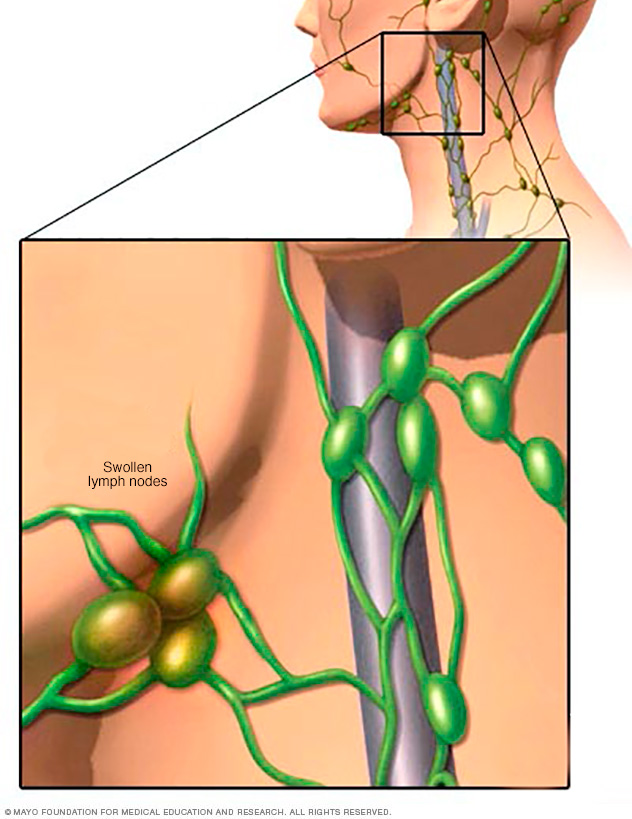 Hodgkin s lymphoma Hodgkin s disease University of Michigan